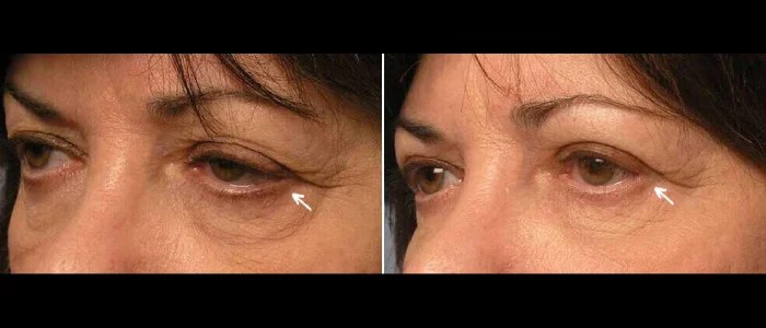 Canthoplasty before after results dubai