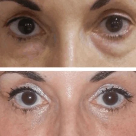 Facial fat transfer under eyes before and after in uae