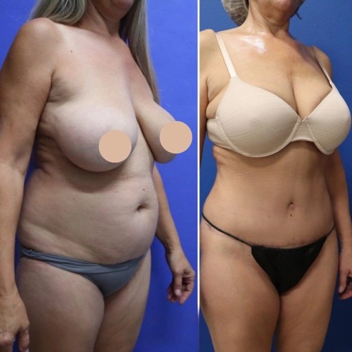 Smart lipo at perfect drs