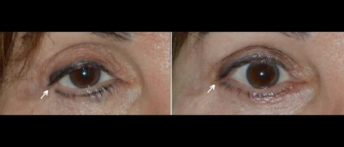 Canthoplasty before after
