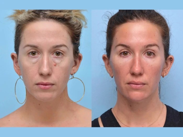 Botox under eyes in dubai