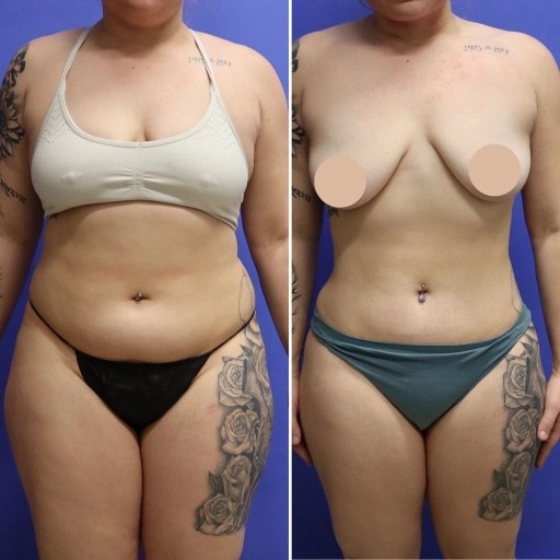 Smart lipo for female in dubai
