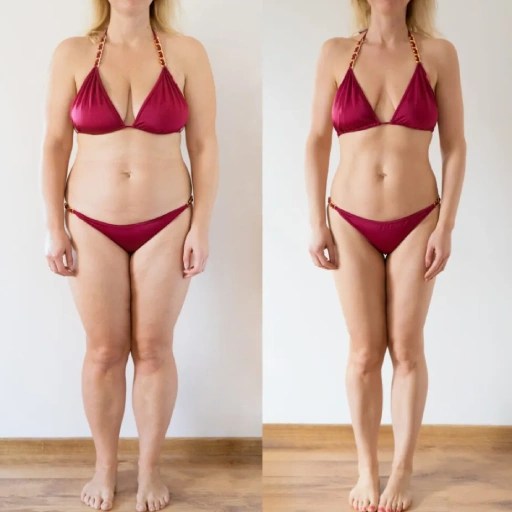 Smart lipo before after at perfect drs