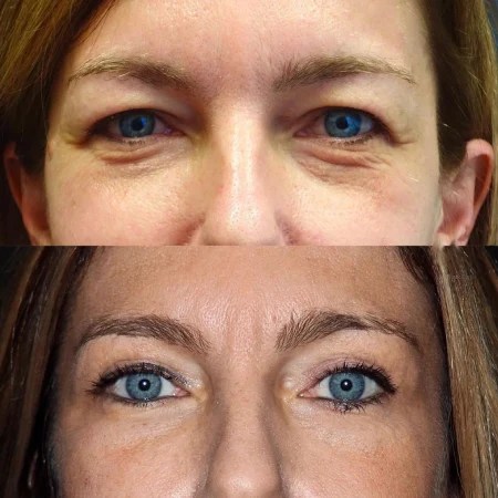 Upper Eyelid Cost In Dubai
