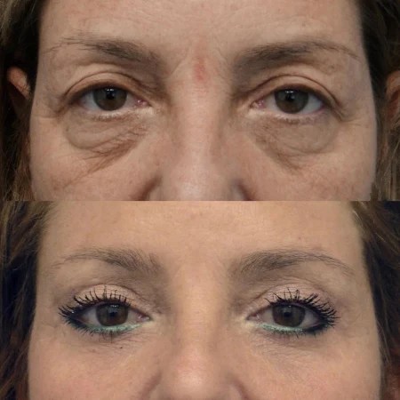 Upper Eyelid Cost In Dubai