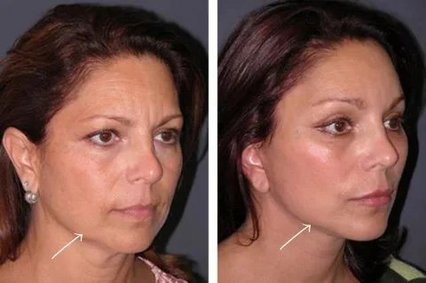 Short scar facelift before after at perfect drs