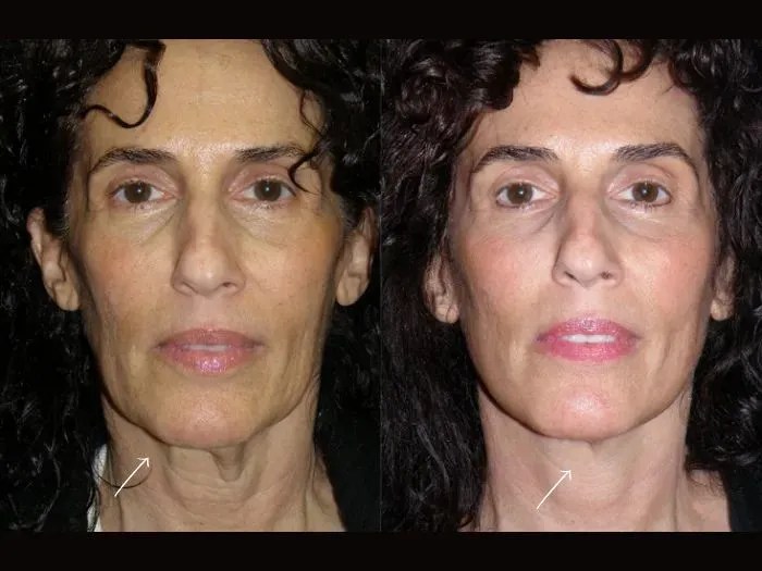 Macs facelift uae before after