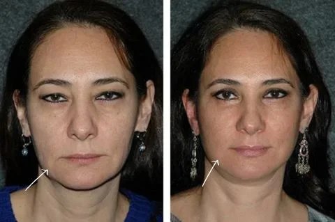 Short scar facelift results before and after uae