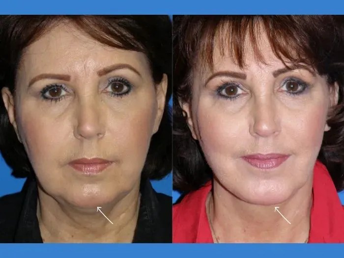 Macs facelift before after results abu dhabi