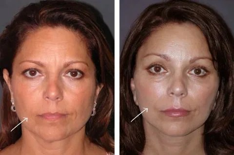 Short scar facelift before after results abu dhabi