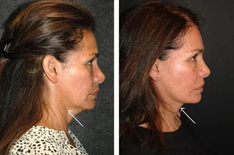 Short scar facelift before after pictures