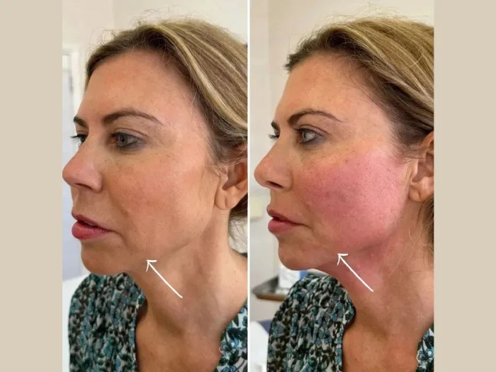 Endolift in Dubai