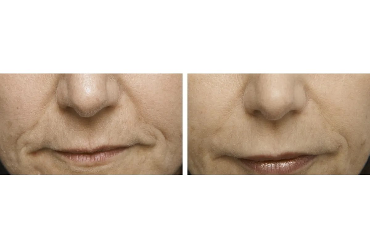 Fine Lines Removal Clinic at Perfect Drs