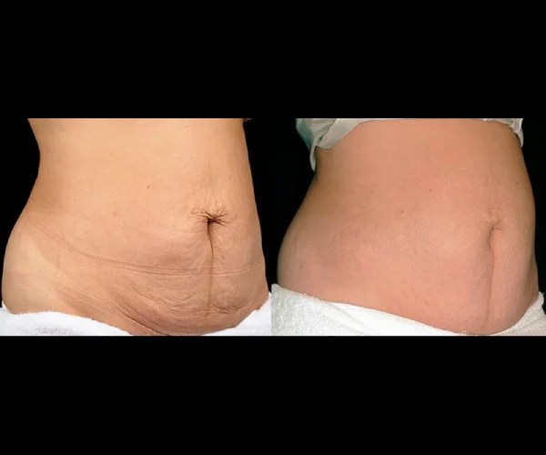 Thermage Skin Lifting Before and After Uae