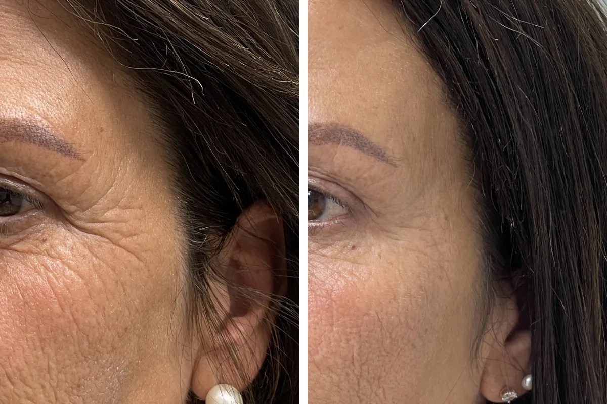 Fine Lines Removal Abu Dhabi