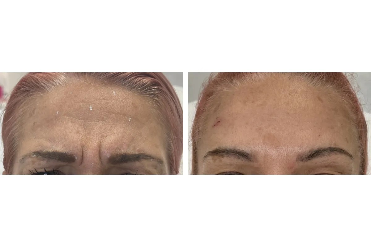Fine Lines Removal Dubai