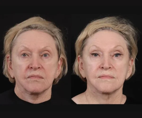 Thermage cpt for face in abu dhabi