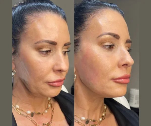 Thermage Facelift Before After at Perfect Drs
