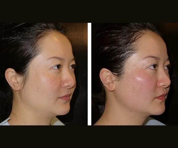 Thermage Facial Contouring Before After Dubai