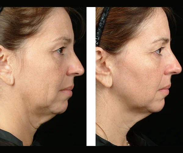 Thermage flx for face transformation at perfect drs