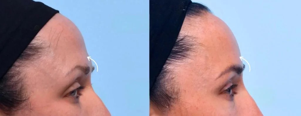 Forehead Fillers Before After Results Abu Dhabi