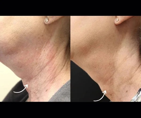 Thermage Before After Treatment at Perfect Drs
