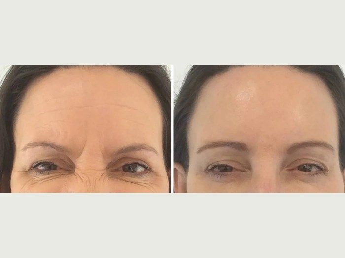Viora St Before After Treatment at Perfect Drs