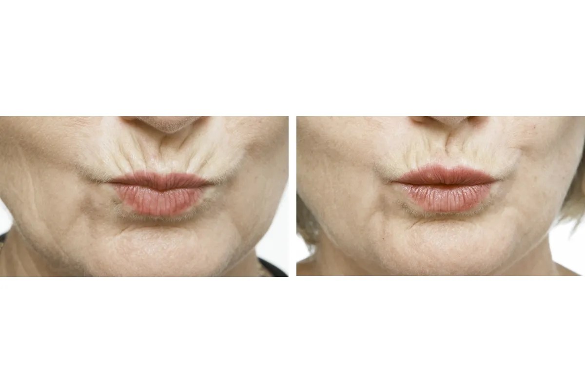 Effective Fine Lines Removal Abu Dhabi