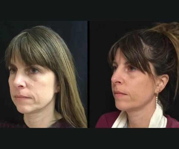 Thermage cpt for face in dubai