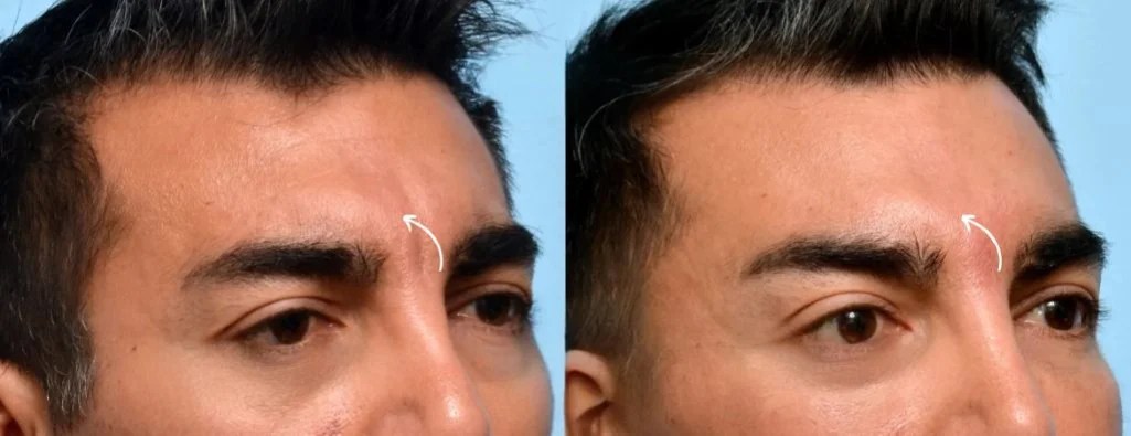Forehead Fillers Before After Results