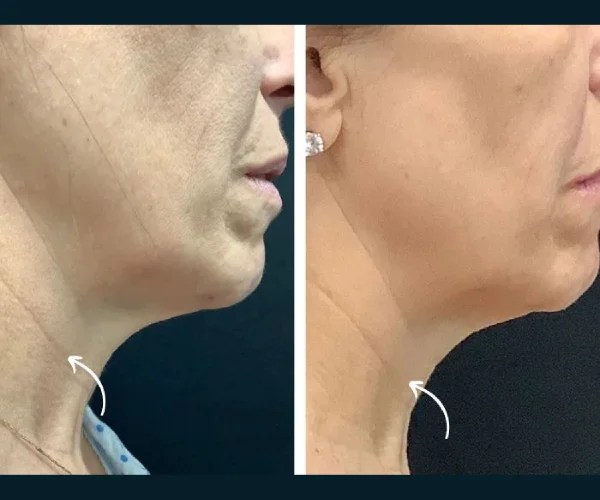 Thermage Results Before and After Uae