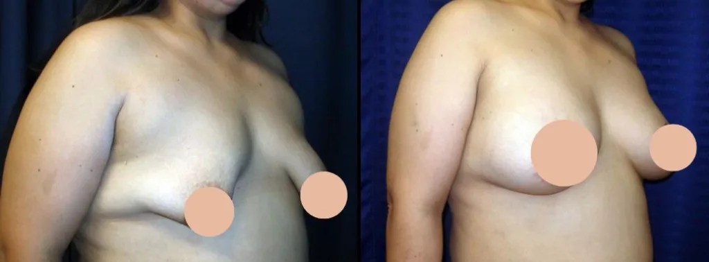 Tuberous breast correction abu dhabi