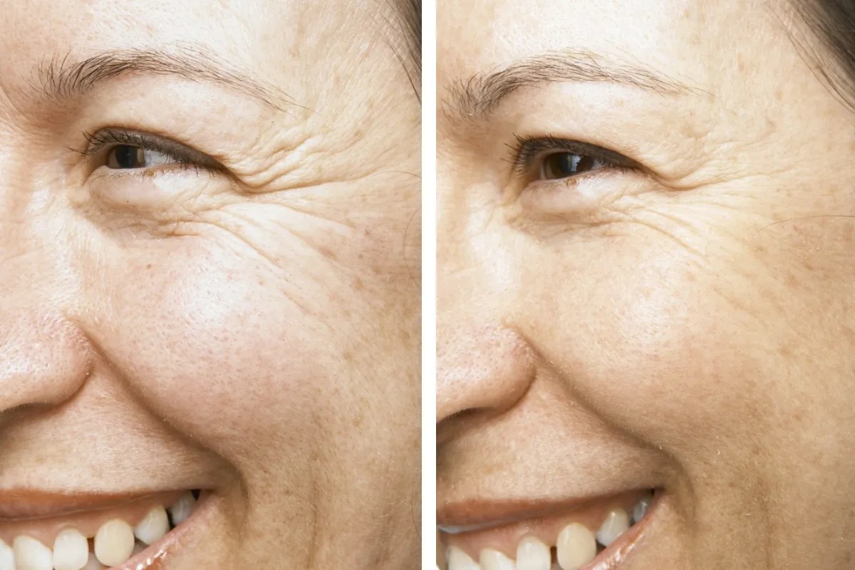 Fine Lines Removal Treatment at Perfect Drs