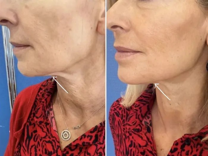 Non-Surgical Endolift Dubai