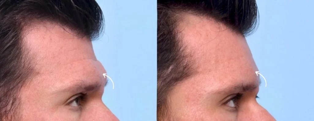 Forehead Fillers Before After Result in Uae