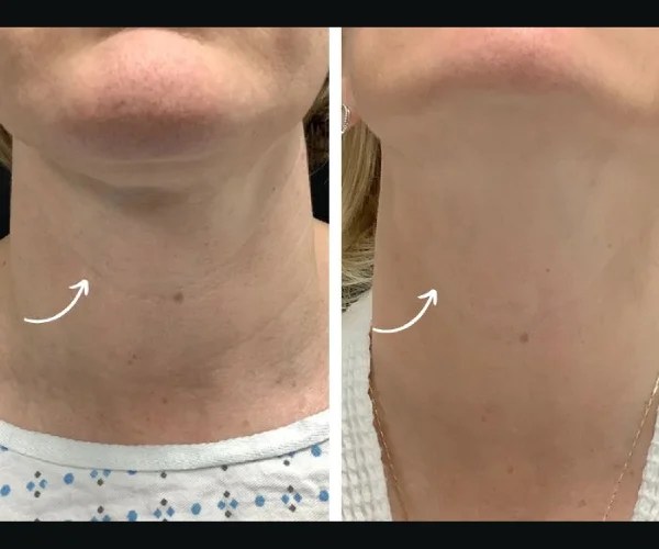 Before and After Thermage at Perfect Drs Uae