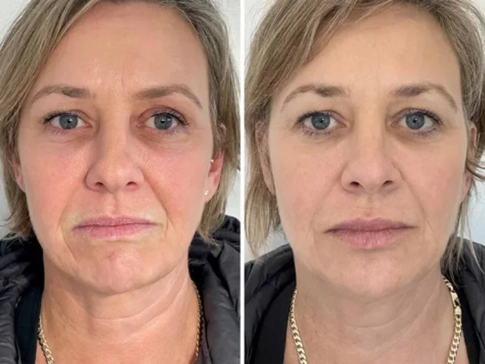 Viora St Results Before and After Uae