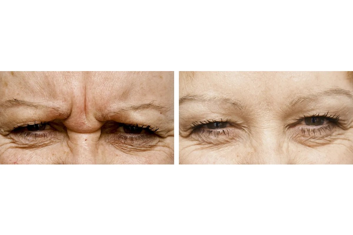 Advanced Fine Lines Removal Abu Dhabi