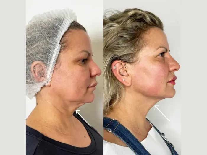 Endolift Face Lifting Abu Dhabi