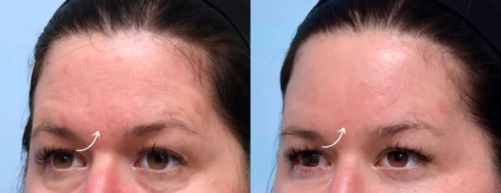Forehead Fillers Before After
