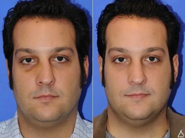 Nasal Fracture Surgery Before After Dubai