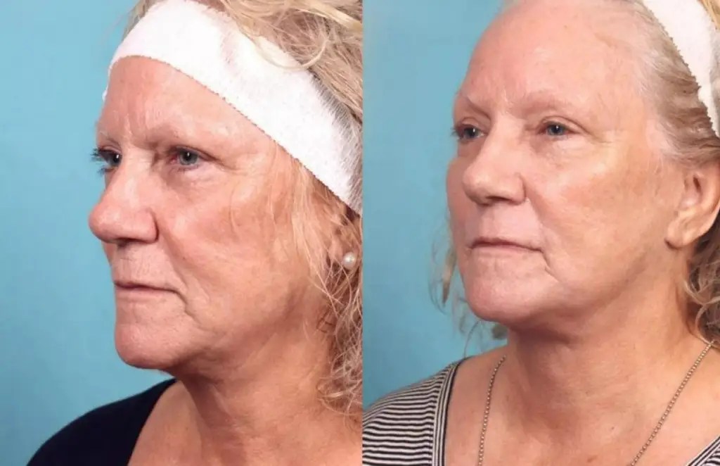 Tca Peel at Perfect Drs