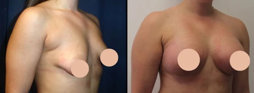 Tuberous breast correction at perfect drs