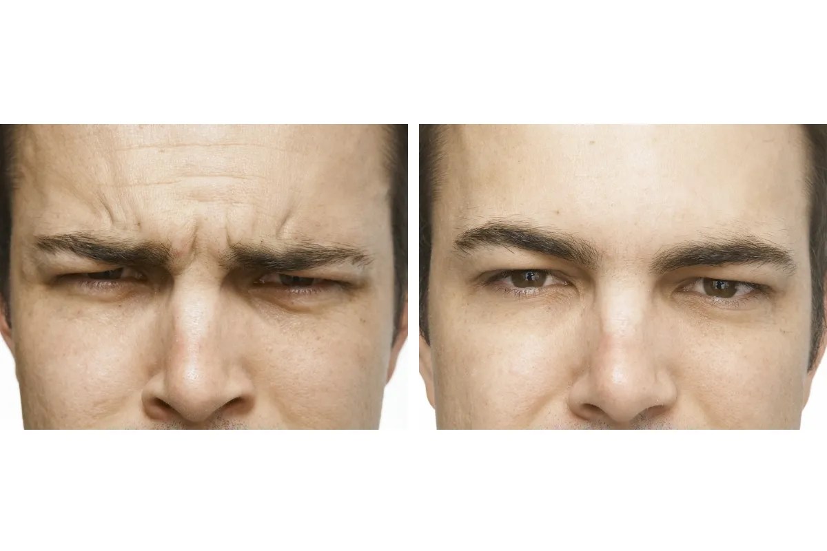 Safe Fine Lines Removal Dubai