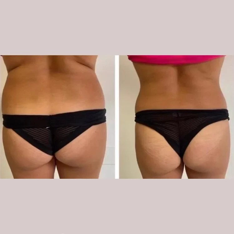 Wonder Axon Before After Results