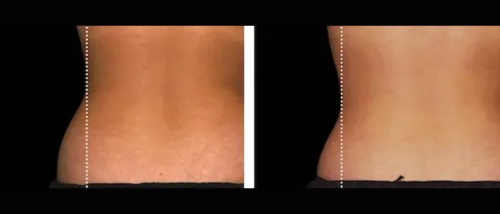 Emsculpt Neo Edge Before After Uae