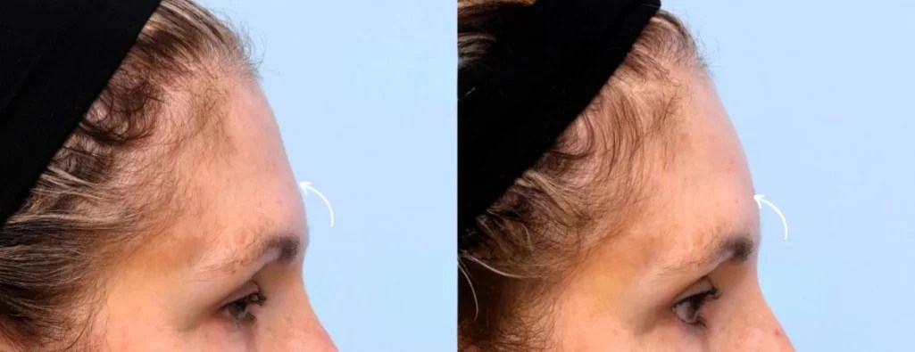 Forehead Fillers Before After Results Dubai
