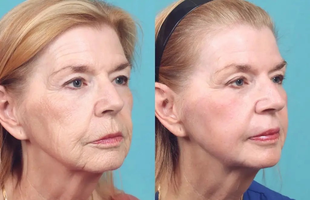 Tca Peel Before After Pictures