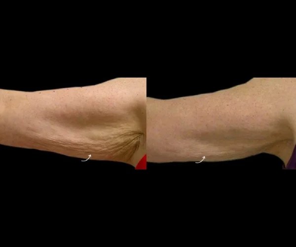 Thermage Transformation at Perfect Drs