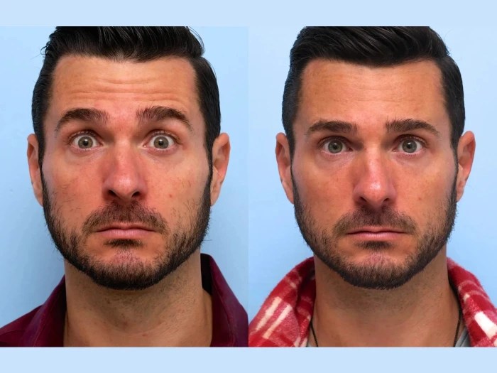 Viora St Before After Uae